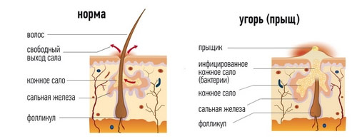 Сальные железы, потовые железы, ЛазерЛеди, два вида потовых желез