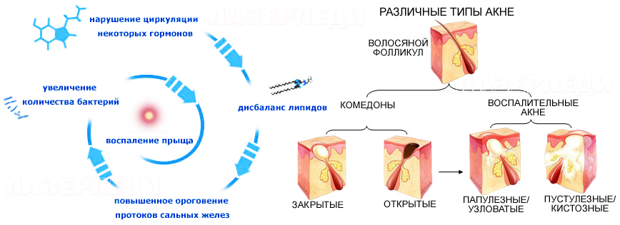 Акнеформный дерматоз, демодекоз, угри, акне, розацеа - диагностика и лечение акне, угри, диагностика, лечение, лазерледи, акнеформный дерматоз, демодекоз, папулезную, пустулезную