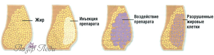 Этапы лечения целлюлита - (МЕЗОТЕРАПИЯ) - мезотерапевтическая коррекция... Этапы лечения целлюлита, мезотерапия, мезотерапевтическая коррекция, ЛазерЛеди, целлюлит, ожирение, мезотерапия целлюлита