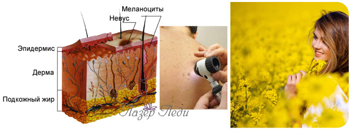 Профилактика и меры предосторожности, предотвращающие развитие меланомы, невус, выбор метода и эффективности лечения, ЛазерЛеди