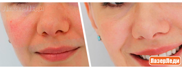 удаление сосудистых звездочек, лазерное удаление сосудов, купероз, rosacea, эритроз, удаление сосудов лазером, телеангиэктазии, гемангиомы, розацеа, винные пятна, лечения сосудов кожи, лазерледи, лицо девушки