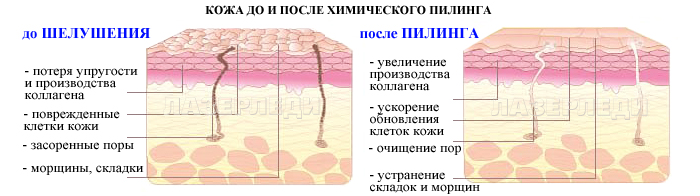 пилинг, кожа до химического пилинга, кожа после химического пилинга, лазерледи, показания для провидения химического пилинга